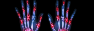 Rheumatoide Arthritis