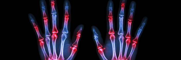 2. fokozatú rheumatoid arthritis